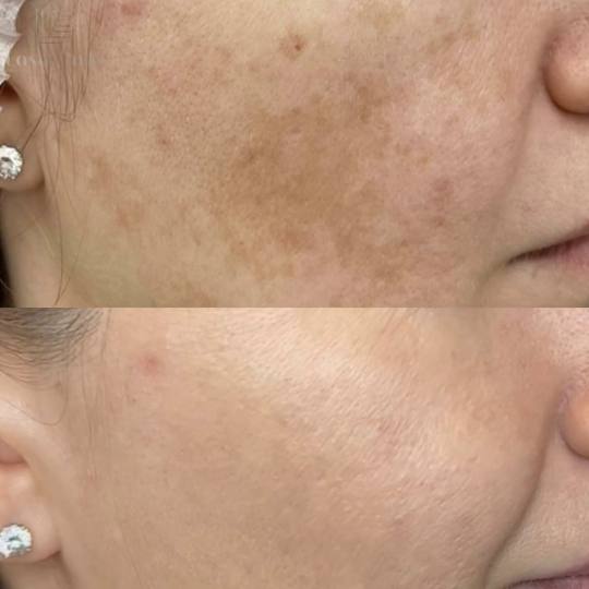 Angela #zagreb Posvjetljivanje pigmentacije