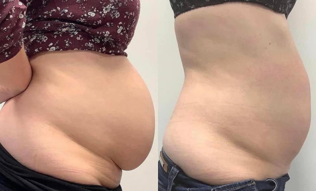 Estetix centar #zagreb Tretmani tijela Emsculpt tretman tijela - paket od 4 tretmana