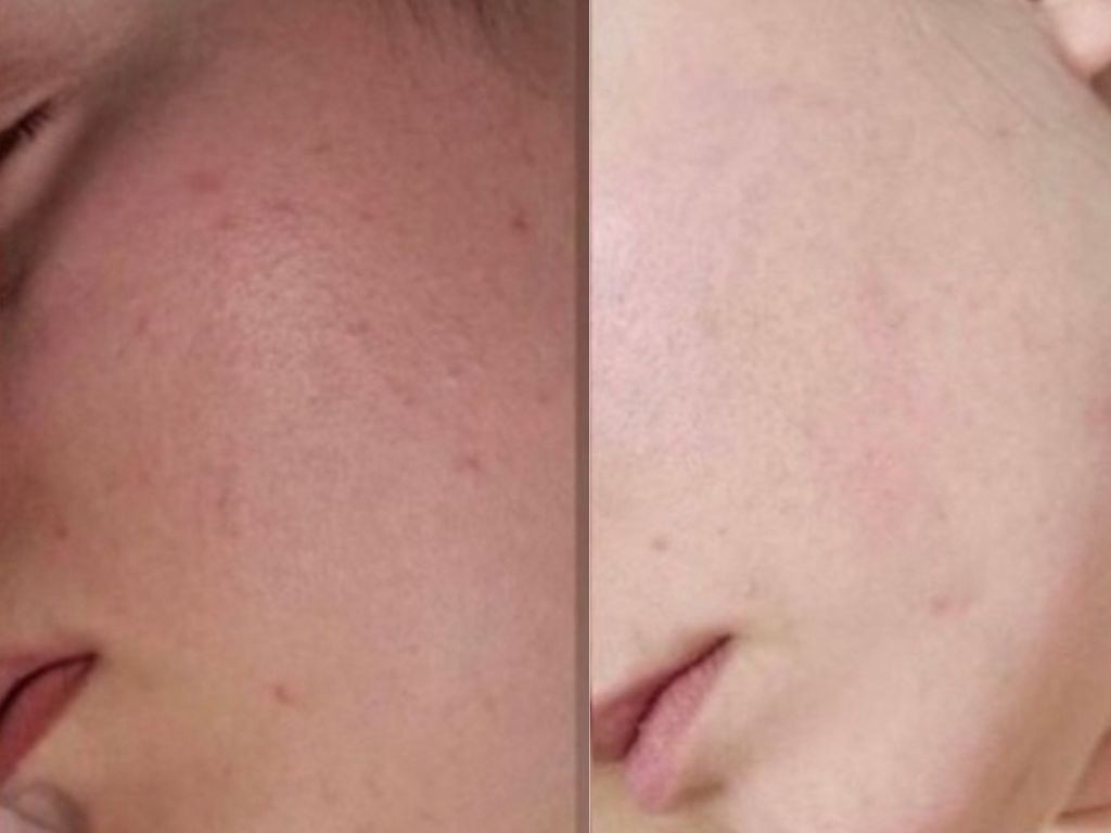 Madero&Beauty Gabrijela #zagreb Dermaroler i dermapen Dermapen - lice