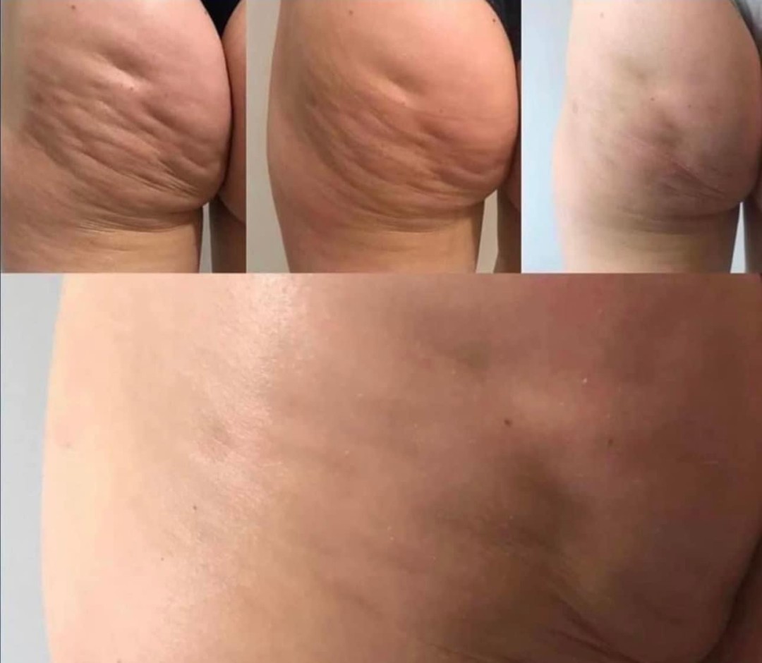 Estetix centar #zagreb Tretmani tijela Hard core paket tretmana