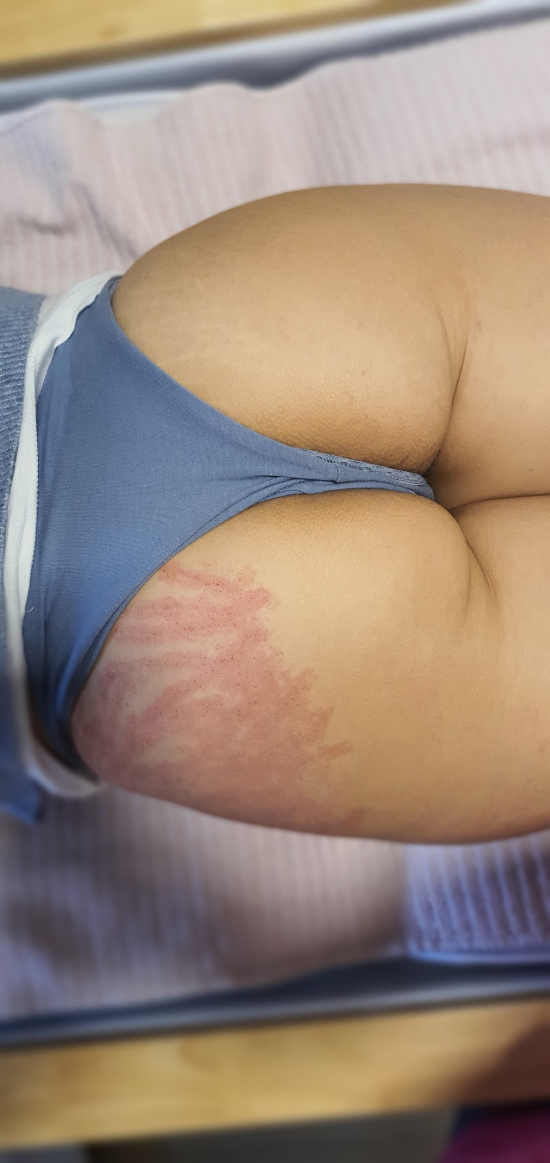 SOLO Beauty Centar #zagreb Odstranjivanje strija Frakcijski laser - tretman za strije