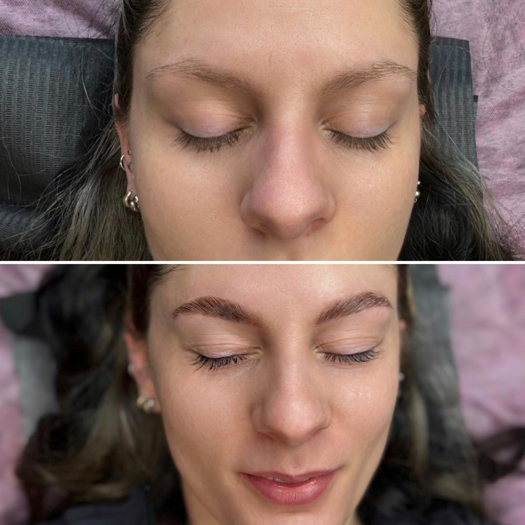 Anova Aesthetics #zagreb Obrve Brow lift