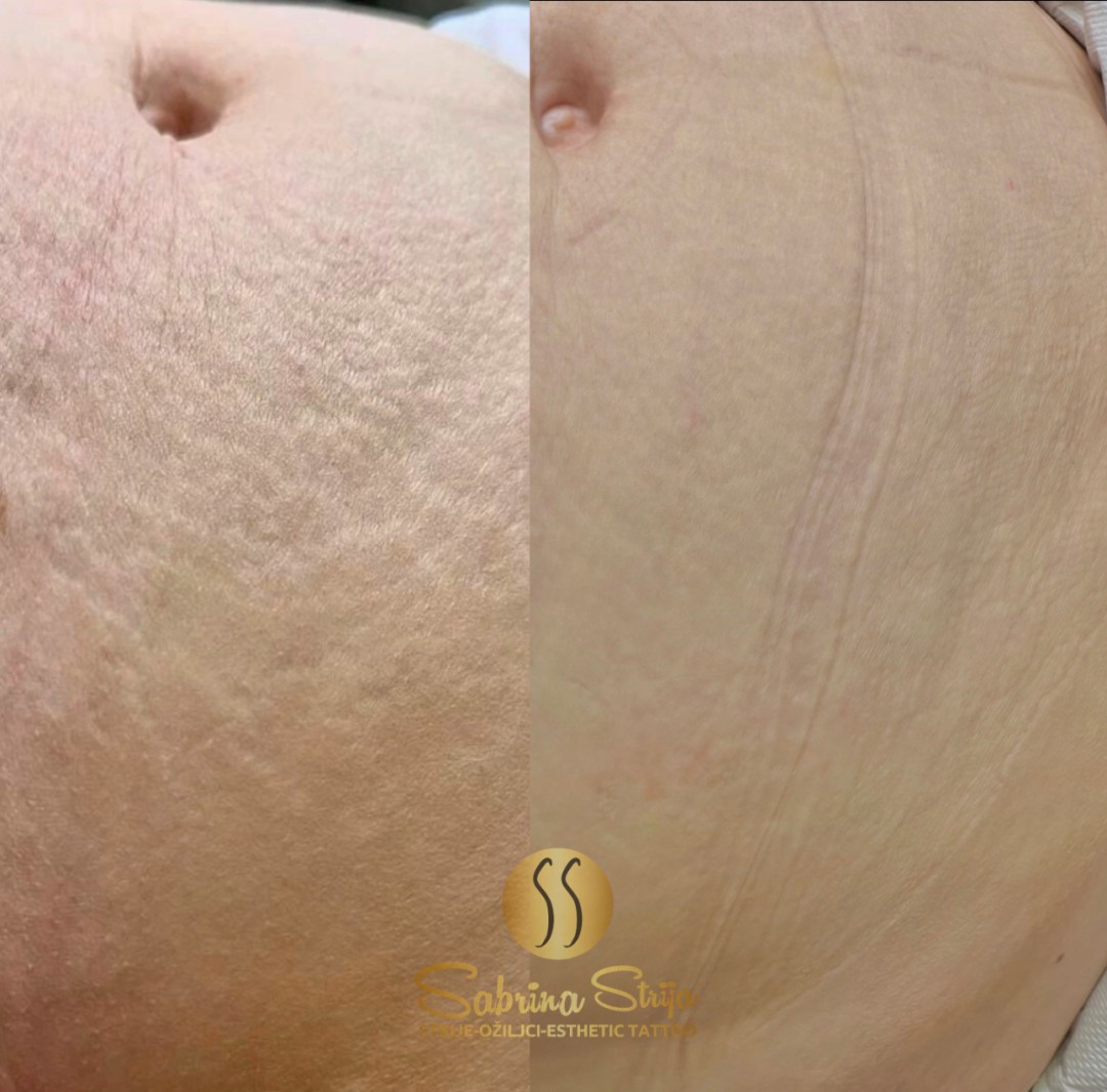 SABRINA STRIJA BEAUTY & SPA #zagreb Tretman ožiljaka Estetsko tetoviranje strija - 1 regija