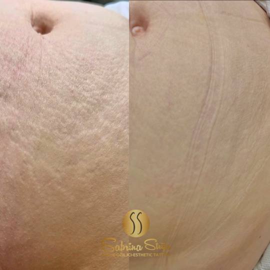 SABRINA STRIJA BEAUTY & SPA #zagreb Tretman ožiljaka Estetsko tetoviranje strija - 1 regija