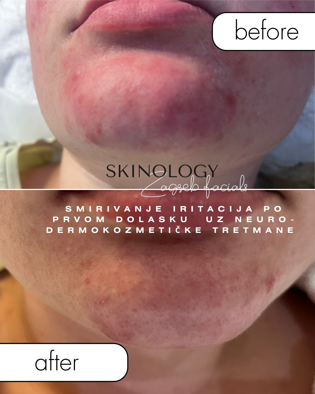 Intense repair - tretman lica - Skinology Zagreb facials, Zagreb Tretman lica Lice Tretman lica, Zagreb, Donji grad - Centar