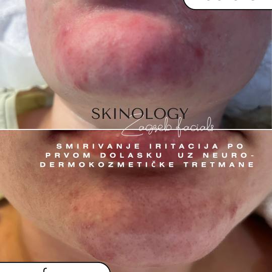 Skinology Zagreb facials #zagreb Tretman lica Intense repair - tretman lica