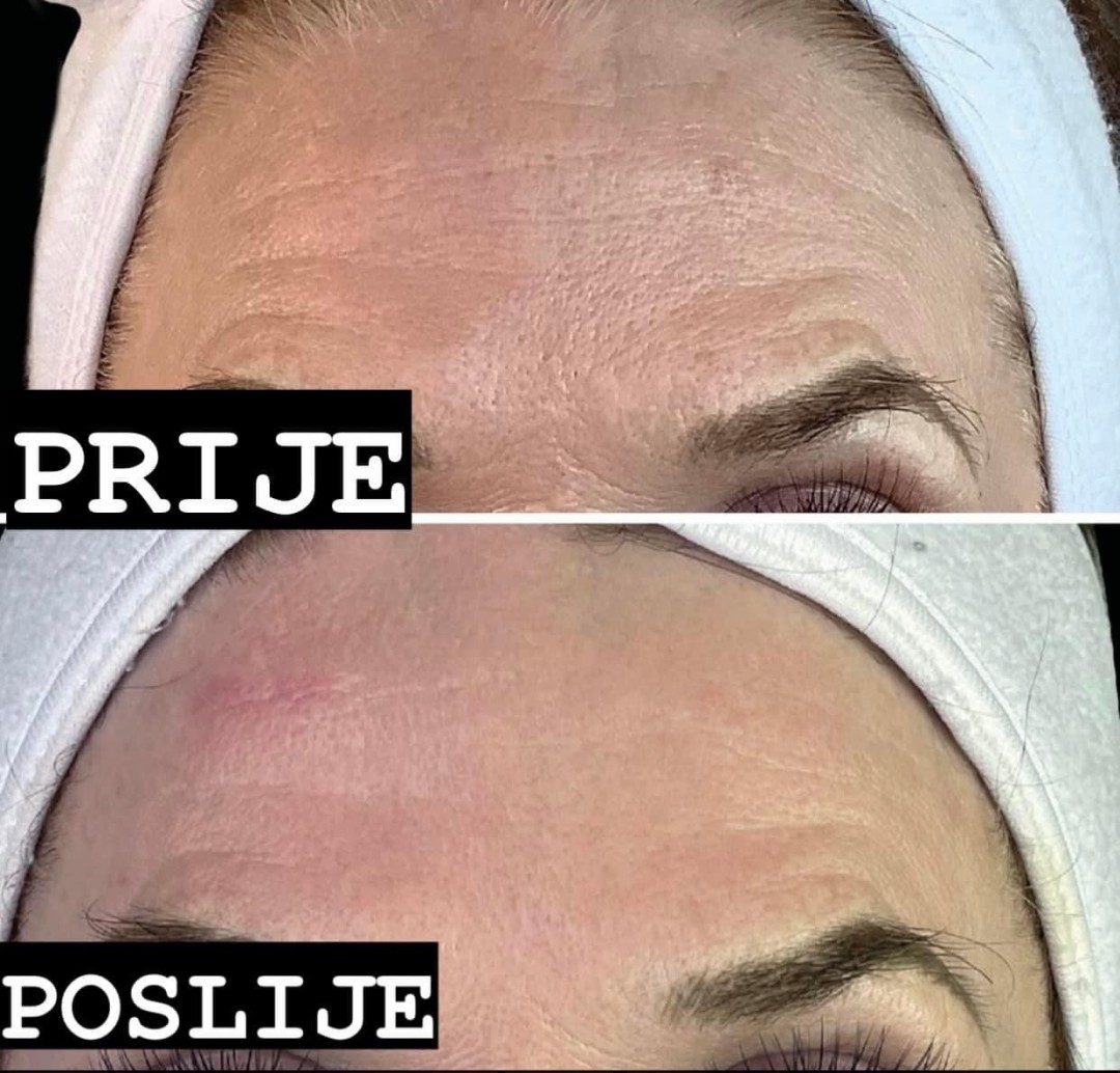 Estetix centar #zagreb Tretman lica EM-face tretman lica - paket od 4 tretmana