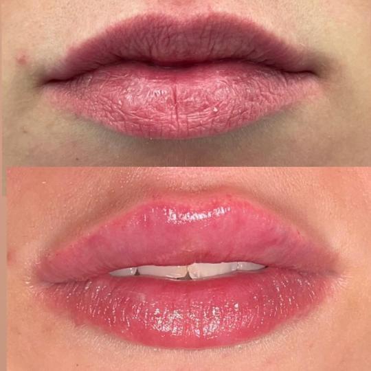 Clinic Burow #split Dermalni fileri Fileri - usne Fileri za usne nježno nadoknađuju volumen, defin