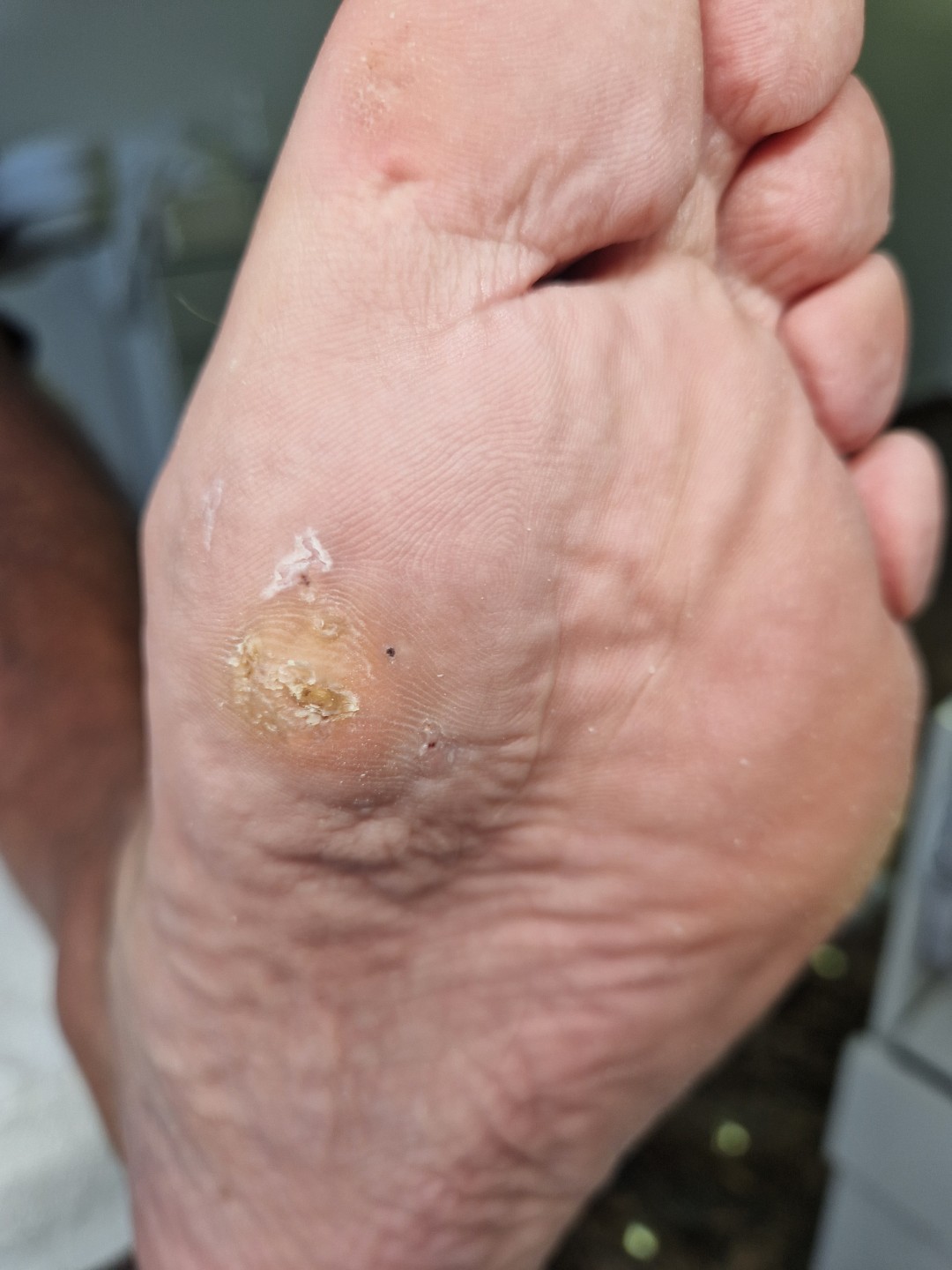 Maja #zagreb Medicinska pedikura Pedikura