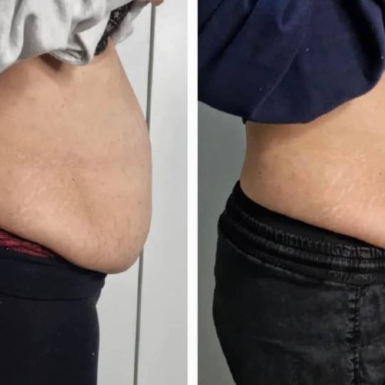 Estetix centar #zagreb Tretmani tijela Emsculpt tretman tijela - paket od 4 tretmana