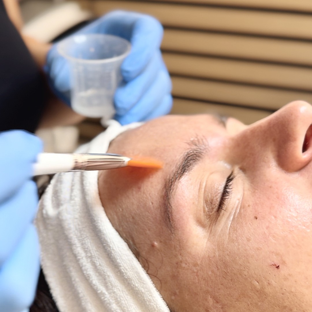 Vanja’s Beautique #zagreb Tretman lica Kemijski piling lica