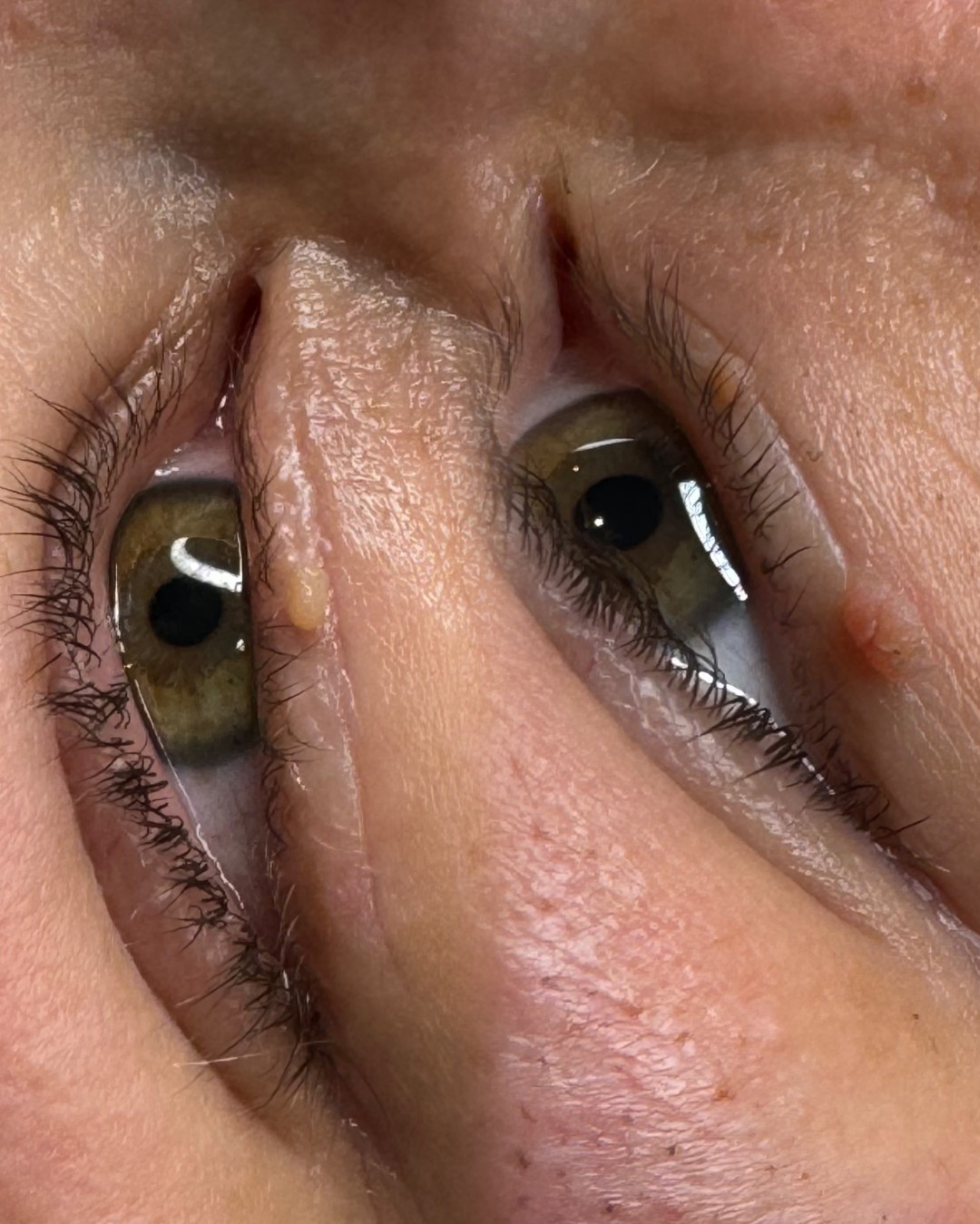 Vanja’s Beautique #zagreb Tretmani tijela Uklanjanje bradavice plasma penom - 1 komad