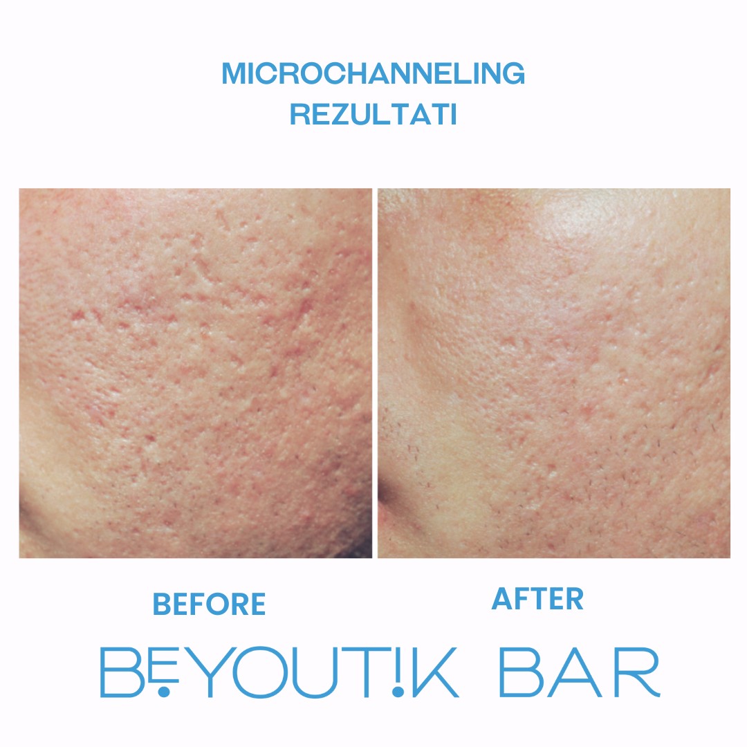 BeYoutik Bar #zagreb Tretman lica Microchanneling - lice