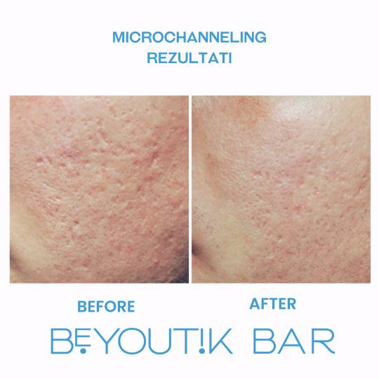 BeYoutik Bar #zagreb Tretman lica Microchanneling - lice *Napomena: Svaka koža je drugačija i potr