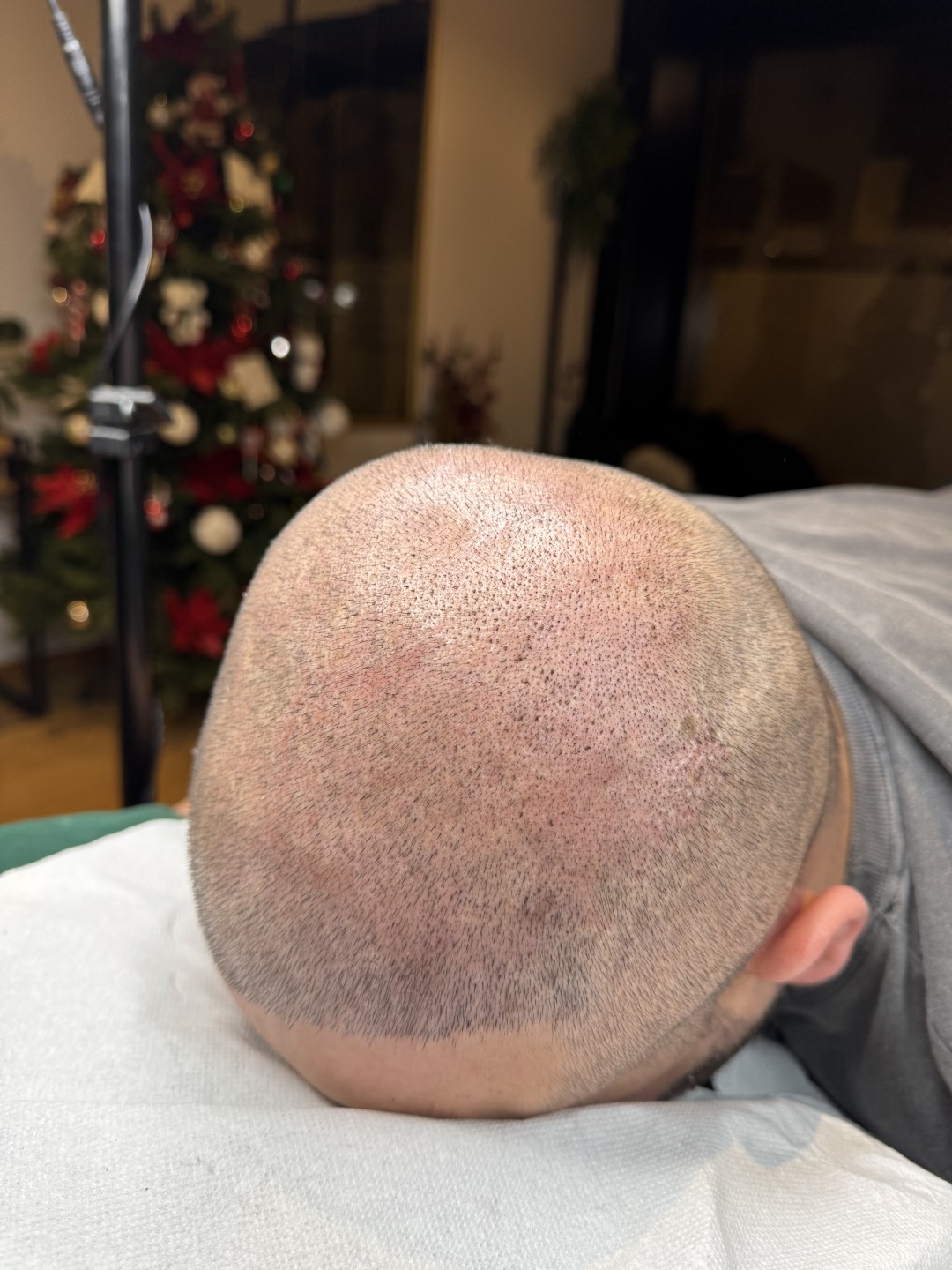 Vanja’s Beautique #zagreb Mikropigmentacija skalpa Mikropigmentacija skalpa - dve regije