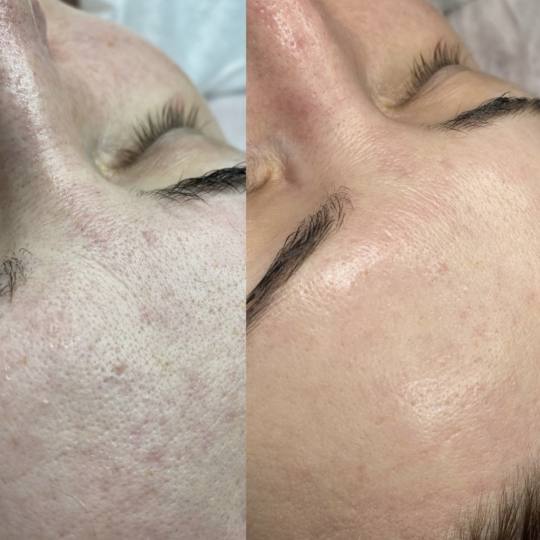 Angela #zagreb Pomlađivanje lica, posvjetljivanje kože i uklanjanje finih bora