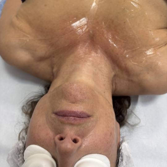 Angela #zagreb Pomlađivanje dekoltea i vrata