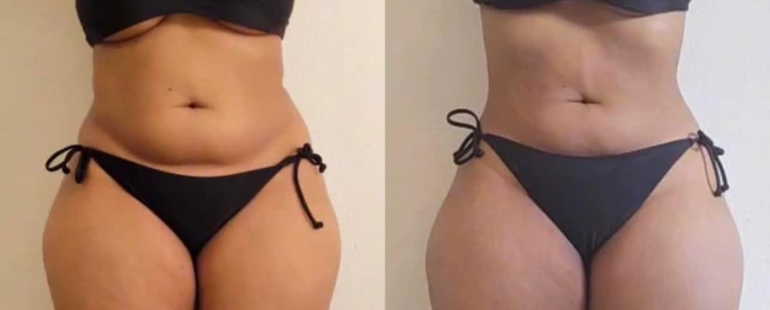 Estetix centar #zagreb Tretmani tijela Indiba 448K tretman tijela - paket od 4 tretmana