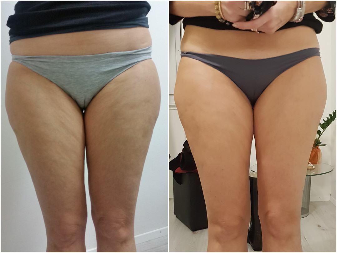 Beauty Centar By Cocco #viskovo Anticelulit masaža