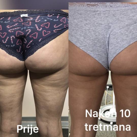 FeelUnique #zagreb Radiovalni i ultrazvučni tretmani LPG oblikovanje + mršavljenje - paket od 10 t