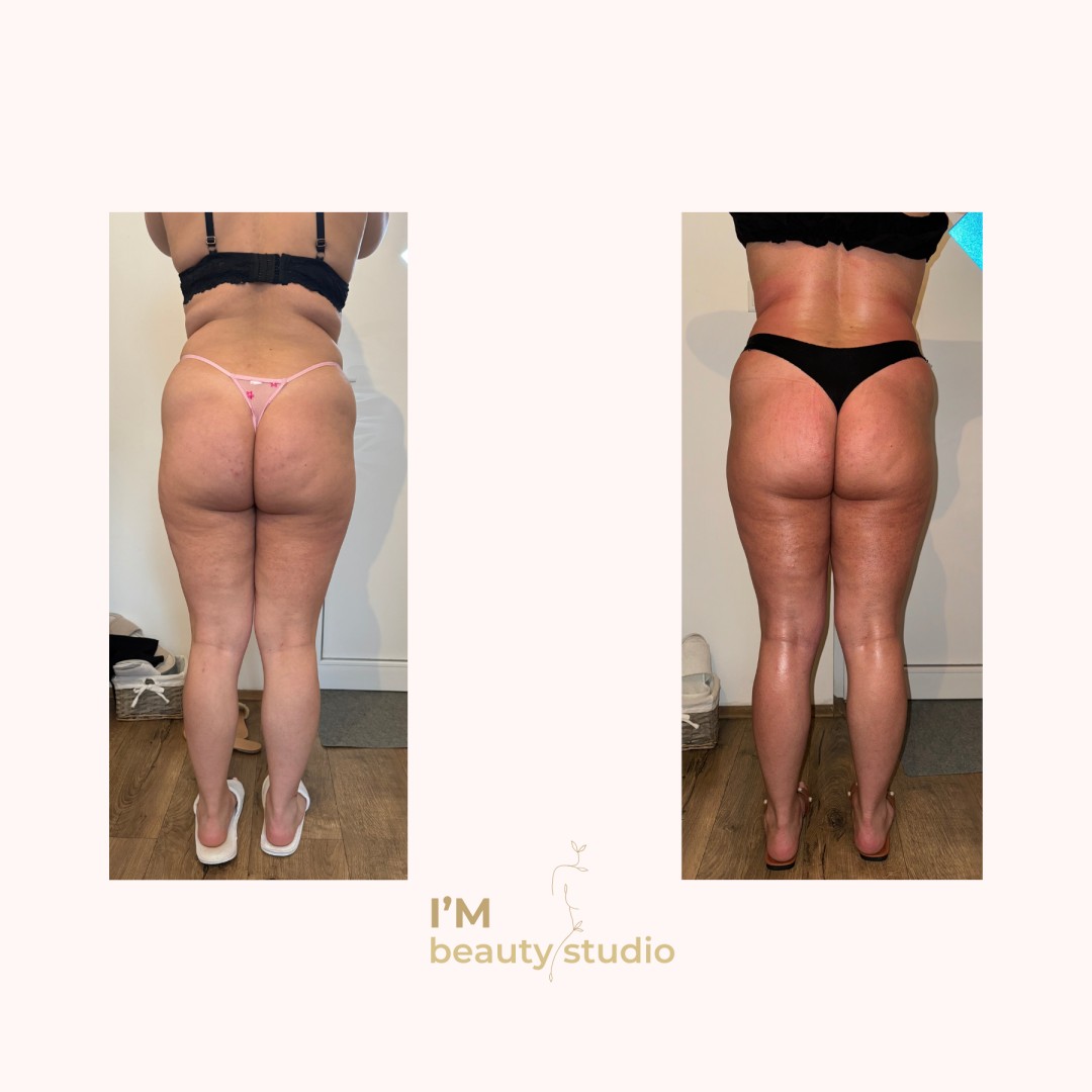 I'M beauty studio #zagreb Anticelulit Promo paket - 10x brazilska maderoterapija (noge gluteus trbuh leđa) - za dame