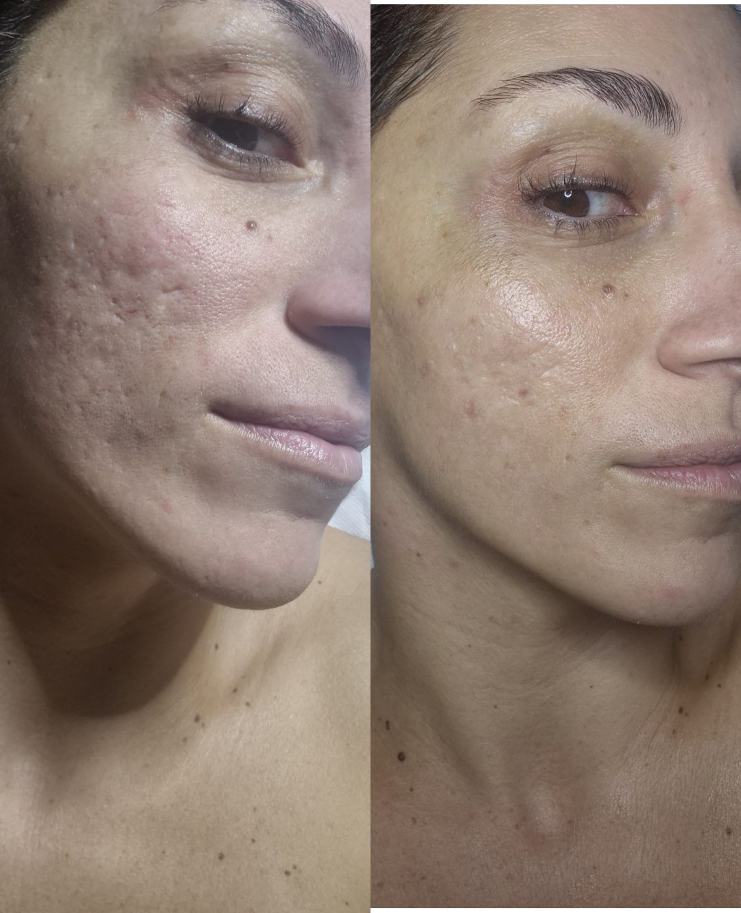 Barbara #zagreb Tretman lica Dijamantska mikrodermoabrazija - mikrodermoabrazija ,maska,masaža ruku ili stopala, korekcija obrva