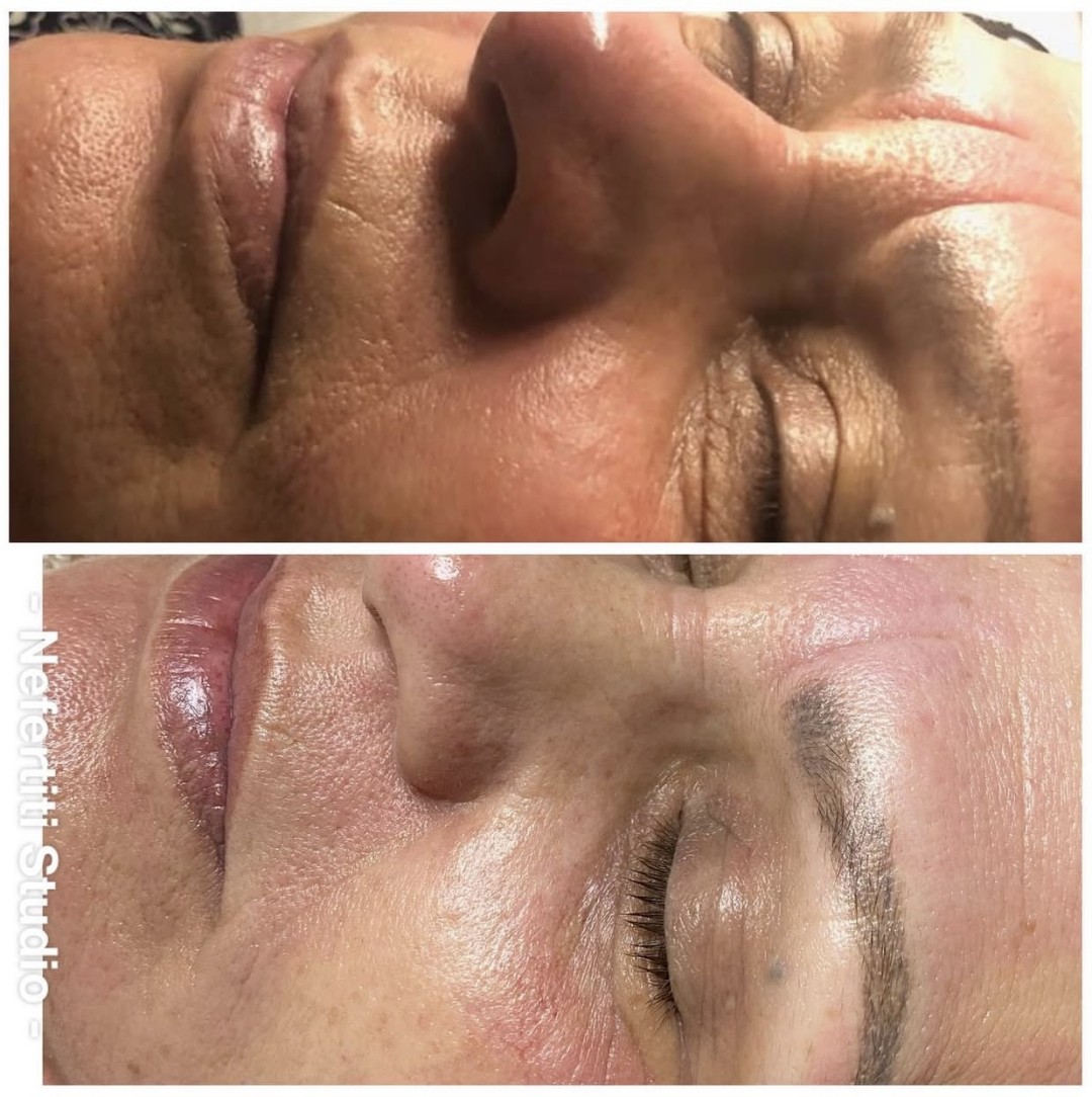 Nefertiti Studio #zagreb Mezoterapija lica Microneedling / Derma Pen lica