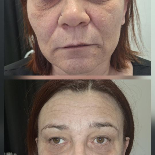 La Belle #zagreb Tretman lica Biostimulacija Pet tretmana lica biostimulacije.Vidljivo glađa i nape