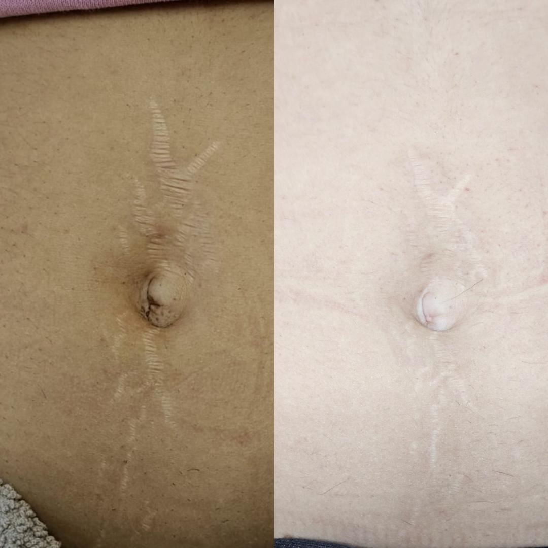 S M Beauty Bloom #zadar Mezoterapija lica Microneedling lica