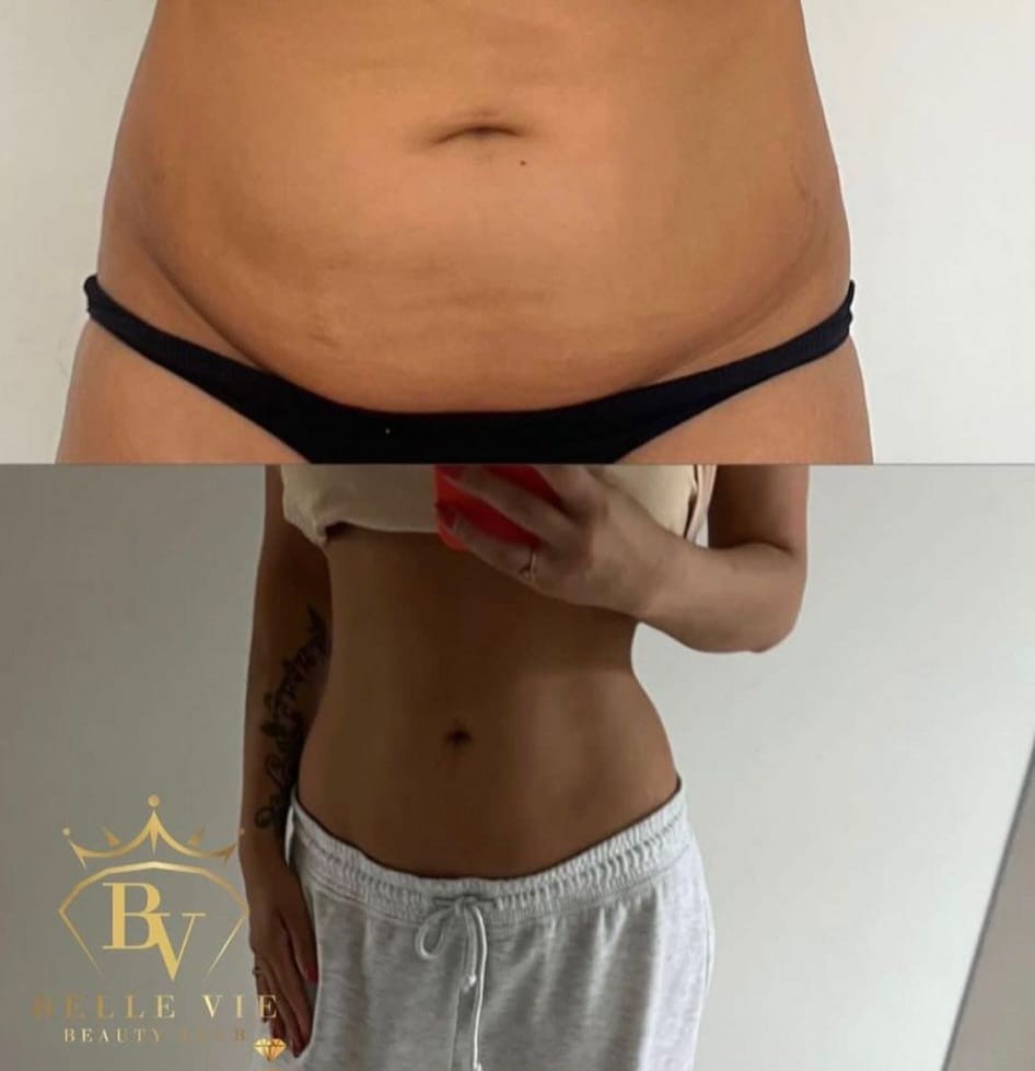 Belle Vie Beauty Club #zagreb Tretmani tijela Tesla tretman dveju regija - paket od 10 tretmana + 2 gratis + RF tehnologija