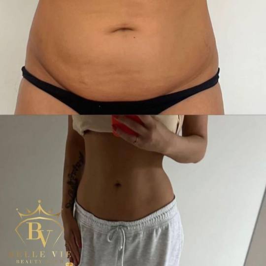 Belle Vie Beauty Club #zagreb Tretmani tijela Tesla tretman dveju regija - paket od 10 tretmana + 2 