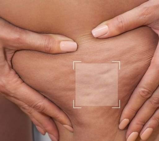 Antiage beauty room Lady Goga #zagreb Anticelulit masaža Ručna anticelulitna masaža