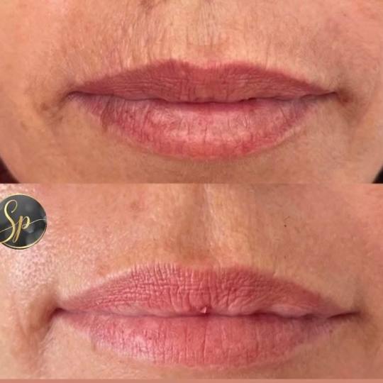 Spellar - Križ #kriz Uklanjanje pusacih bora - plasma pen