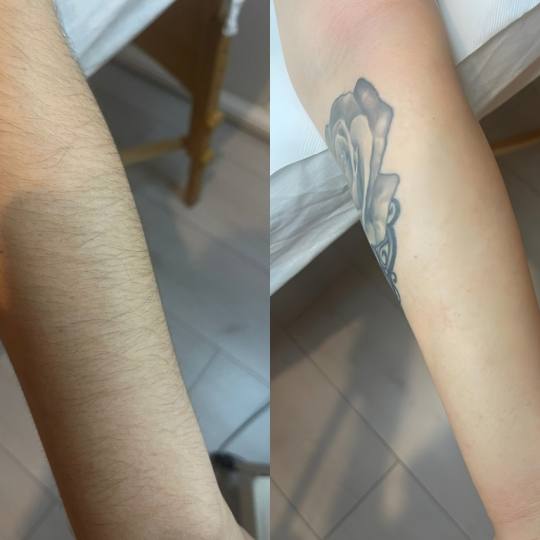 Madero&Beauty Gabrijela #zagreb Prije i poslije depilacije ruku.