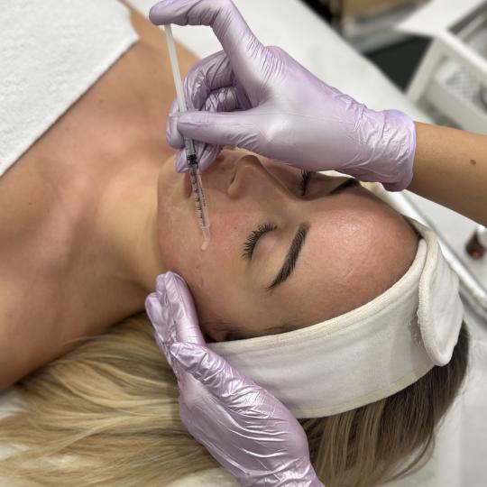 Beauty Box - Zagreb #zagreb Tretman lica Microneedling