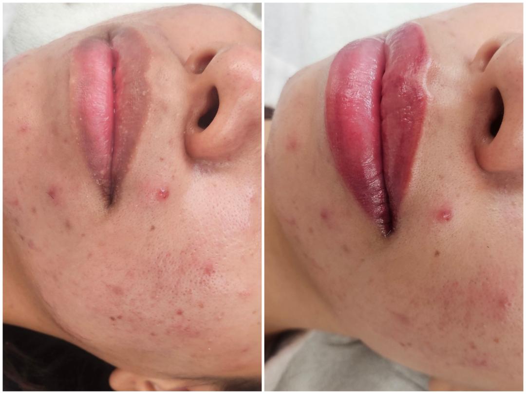 Cosmoderm & Centar Estetica #zagreb Trajna šminka Trajna šminka - usne - lip blush