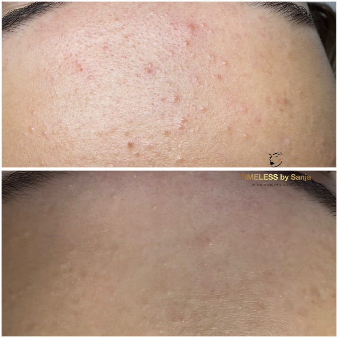 Timeless by Sanja #zagreb Piling lica Mesoestetic peeling