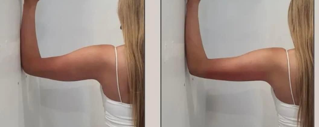 Estetix centar #zagreb Tretmani tijela Emsculpt tretman tijela - paket od 4 tretmana