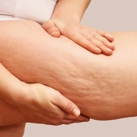 Aromavita Bella Donna #varazdin Anticelulit masaža Anticelulitna masaža Specijalizirana masaža ko