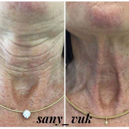 Sany Nails & Cosmetics #zagreb Tretman lica  ACCOR Cosmetics Corrector je nježna alternativa operac