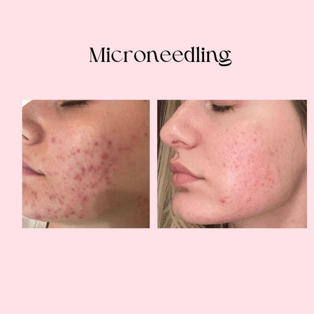 Microneedling lica - Bio+klinik, Zagreb Mezoterapija lica Lice Mezoterapija lica, Zagreb, Maksimir