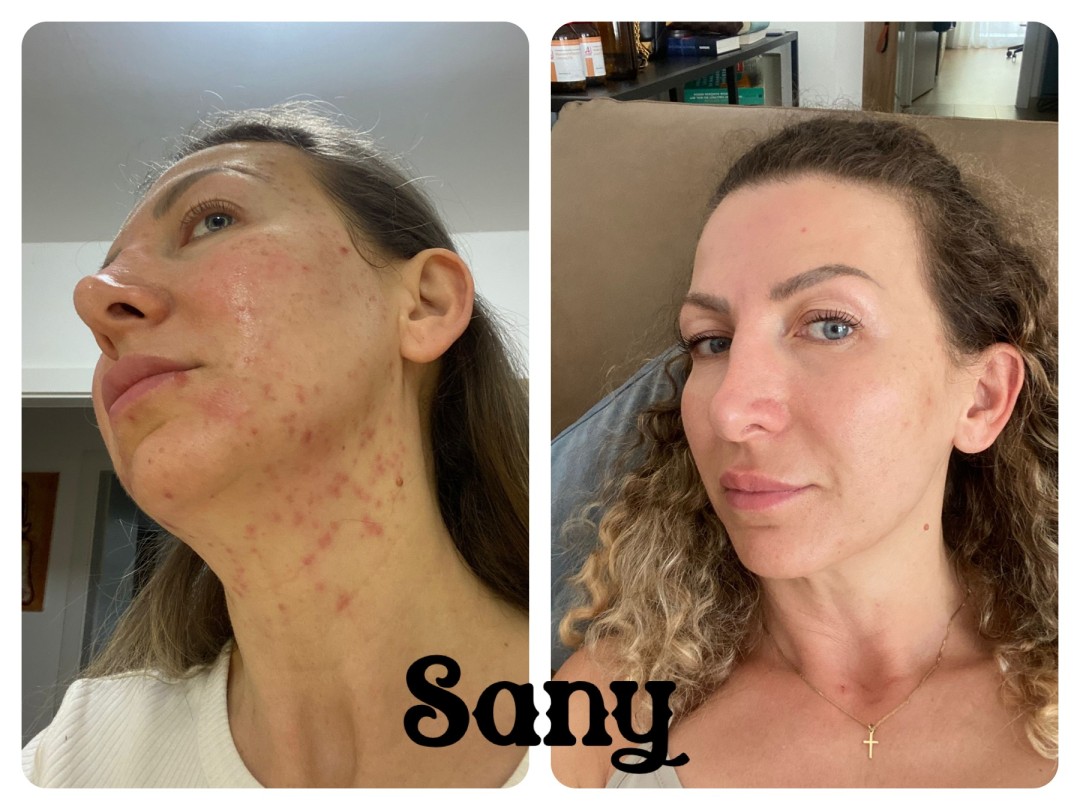 Sany Nails & Cosmetics #zagreb Mezoterapija lica