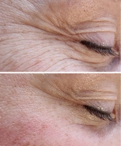 Antiage beauty room Lady Goga #zagreb Tretman lica