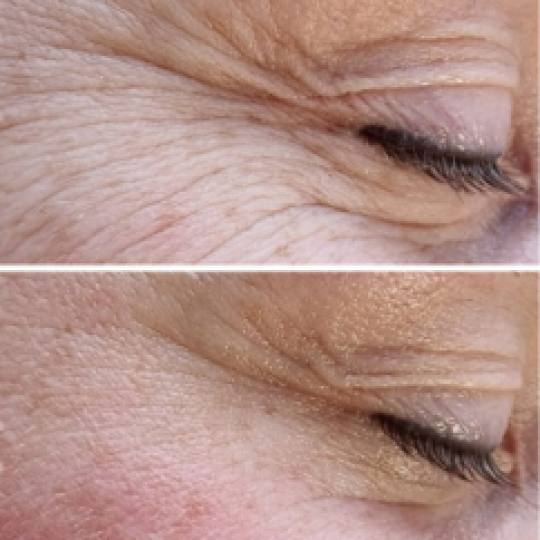 Antiage beauty room Lady Goga #zagreb Tretman lica