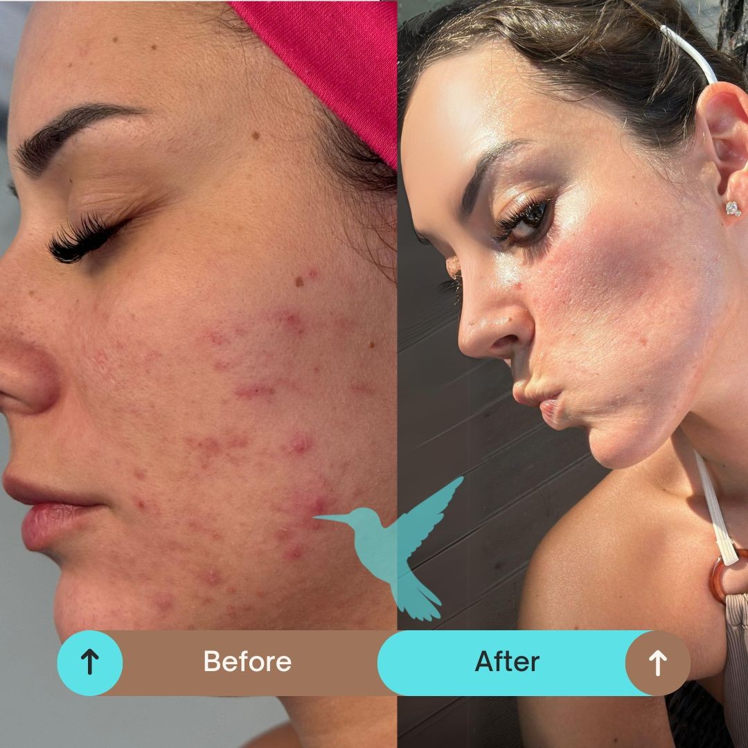 Luma Medic #zagreb Tretman lica SQT resurfacing