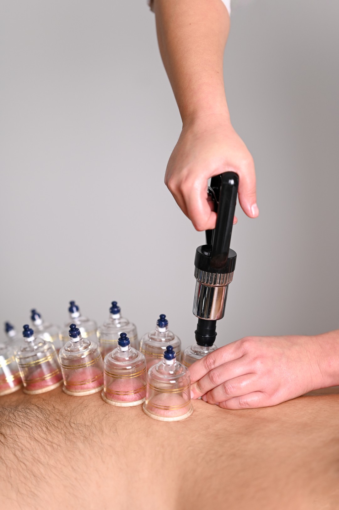 Belušić #zagreb Tretmani tijela Cupping terapija