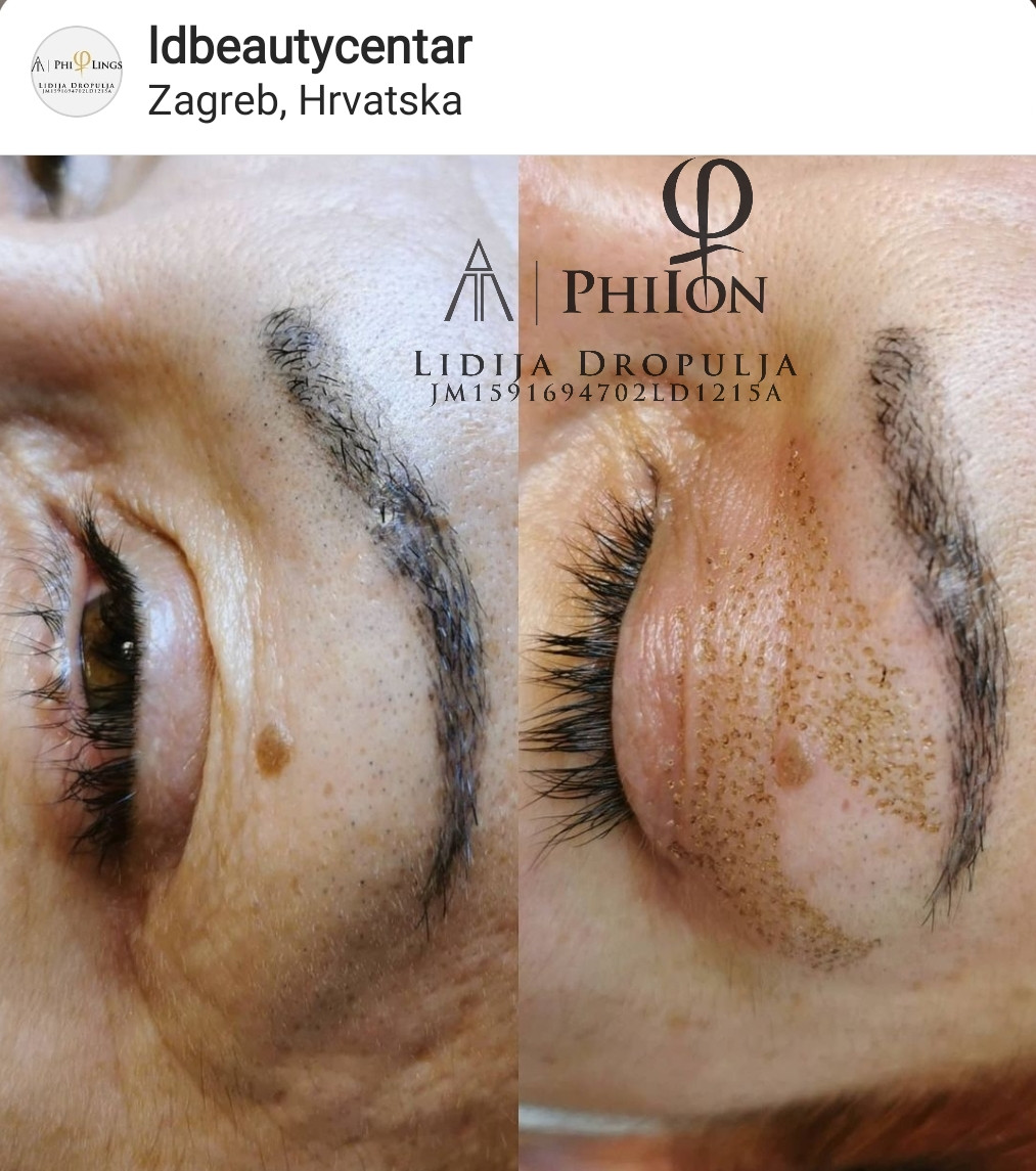 LD Beauty Centar #zagreb Tretmani protiv bora Nekiruško podizanje kapaka