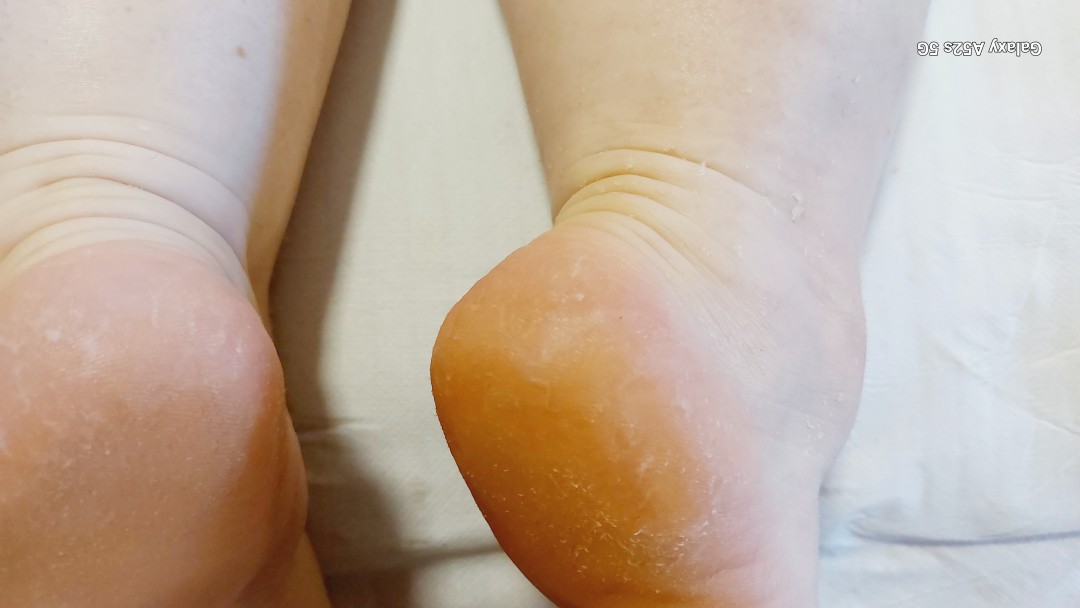 Antiage beauty room Lady Goga #zagreb Medicinska pedikura Pedikura problematičnog stopala