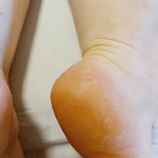 Antiage beauty room Lady Goga #zagreb Medicinska pedikura Pedikura problematičnog stopala