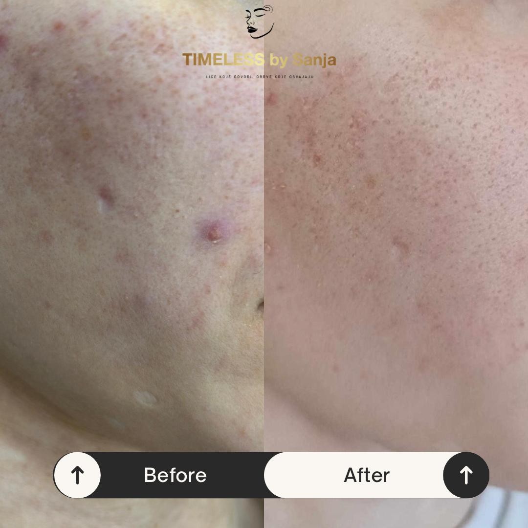 Timeless by Sanja #zagreb Tretman lica KRX - Green sea peel